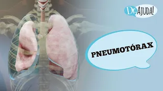 PNEUMOTÓRAX: O QUE É, SINTOMAS, CAUSAS, DIAGNÓSTICO E TRATAMENTO