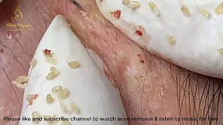 Watch blackhead extract and listen to music for free 177 | Loan Nguyen