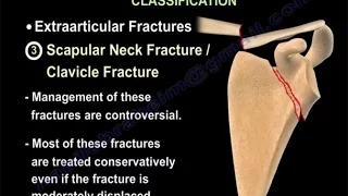 Scapular Fractures, types and treatment - Everything You Need To Know - Dr. Nabil Ebraheim