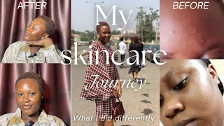 My skincare journey/ mistakes /What I did differently/What transformed my skin