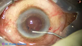 Totally Unedited Phaco - with Weak zonule, not-well-dilated pupil - Pradip Mohanta, 18th Feb, 2024