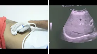 Liver Ultrasound Protocol In Transverse Scan