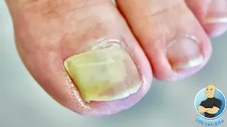 DAMAGED BIG TOENAIL COMPLETELY LIFTED!!! **HOW TO TREAT LIFTED TOENAILS**