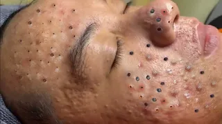 Remove Blackheads and Hidden Acne At Loan Nguyen Spa #176