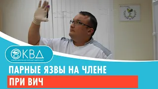 💣 Парные язвы на члене при ВИЧ. Клинический случай №376