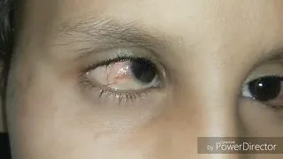 Vernal keratoconjunctivitis