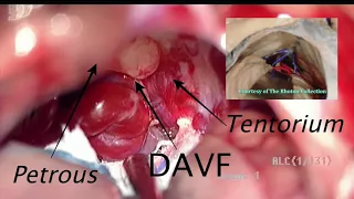 Surgical Clipping of a Petrosal Tentorial Dural Arteriovenous Fistula (Lawton's Type 5)