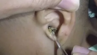 2 Year Old Boy's Giant Dry Earwax Removal