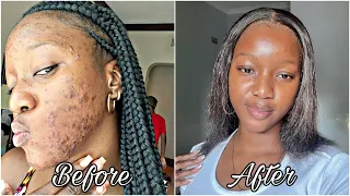 How I finally cleared my acne prone skin + Skin care routine🧴*with photo evidence*