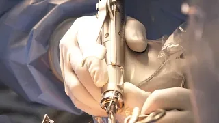 Watch knee replacement using the MAKO Robotic arm