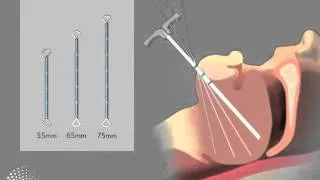 Revent Zungengrund-Implantat bei obstruktiver Schlafapnoe (deutsch)