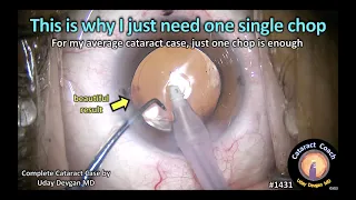 CataractCoach 1431: just one chop needed for cataract surgery -- here is why