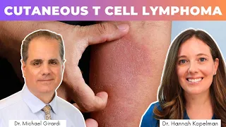 Cutaneous T Cell Lymphoma (CTCL) | Dr. Michael Girardi