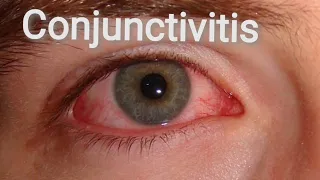 Conjunctiva | Anatomy | Conjunctivitis... Part. 1