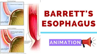 Barrett's Esophagus - Pathology, Dysplasia and Carcinoma