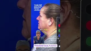 57 years old two months after facelift. Wow! Without general anesthesia. Awake. Dr Madnani, New York