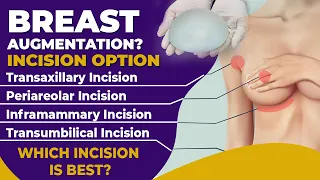 What is the Best Incision for Breast Augmentation? Choose the Right Incision for Breast Augmentation