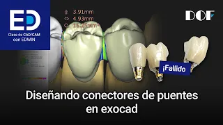 Diseñando conectores de puentes en exocad