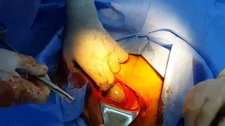 Step-by-step caesarean section - step 2 - uterine incision