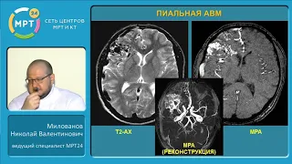Ангиодисплазия головного мозга