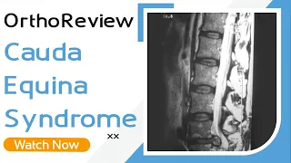 OrthoReview - Cauda Equina Syndrome