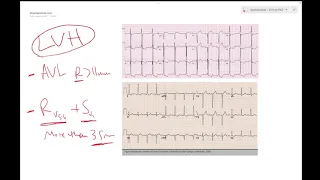 LVH on ECG (Left ventricular hypertrophy) - Learn ECG! - Dr Jamal USMLE