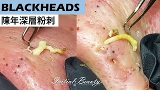 陳年深層粉刺( deep blackheads ) - Taiwan Tainan台南清粉刺最乾淨