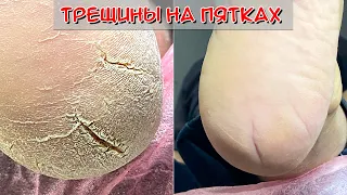 Трещины на пятках /Грибок на ногах