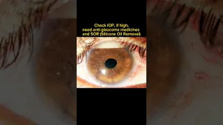Inverse hypopyon #retina #clinical #intresting #eye