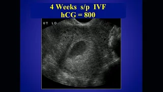 Evaluation of Ectopic Prenancy