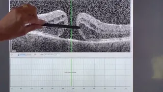 Macular Hole Surgery