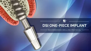 DSI One-piece Compressive Implant - Recommended Drilling Protocol