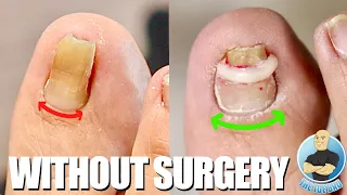 FIXING A PINCER TOENAIL WITHOUT SURGERY ***SEVERE INGROWN TOENAIL TREATMENT***