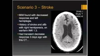 Global Grand Rounds: Acute Stroke Therapy presented by Karl E. Misulis, MD, PhD