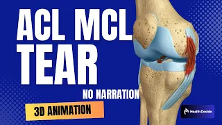 ACL (Anterior Cruciate Ligament) MCL (Medial Collateral Ligament) Tear and Repair (No Narration)