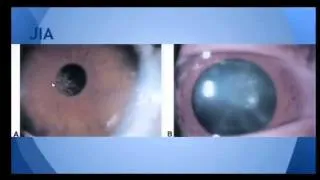 Clinical Pearls- Ophtalmology- Dr. Linda Lehman, 4/23/14