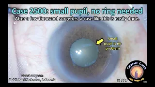 CataractCoach™ 1667: case 2500 small pupil but no hooks, no ring needed