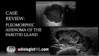 Ultrasound of Pleomorphic Adenoma of the Parotid Gland