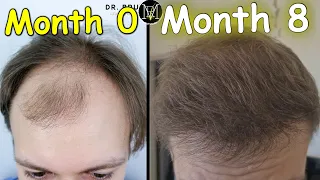 8 months after FUE Hair Transplant | 3500 grafts | Norwood 5a