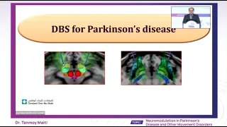 Dr. Tanmoy Maiti - Neuromodulation in Parkinson’sDisease and Other Movement Disorders