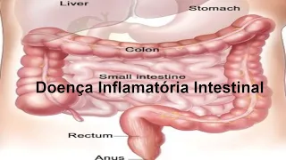 Doença Inflamatória Intestinal (Doença de Crohn  e Retocolite Ulcerativa )