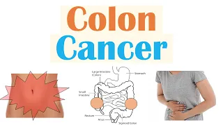 Colon Cancer (CRC) Risk Factors, Pathogenesis, Symptoms, Diagnosis, Staging, Treatment