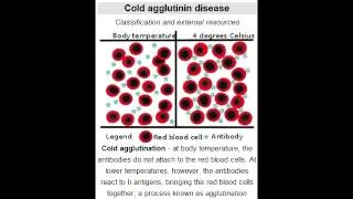Cold Agglutinin Disease (autoimmune hemolytic anemia: Mycoplasma Pneumoniae & Mononucleosis)