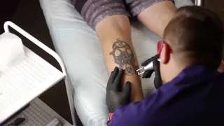 Процесс удаления татуировки в тату студии Синяя Борода