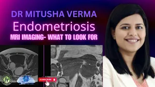 MITUSHA VERMA | ENDOMETRIOSIS - MRI Imaging || MRI TEACHING COURSE