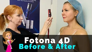 Does Fotona 4D Work? Laser facelift Before & After Photos | Skin Rejuvenation at the Women’s Clinic