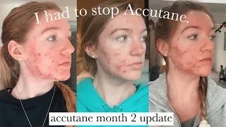 ACCUTANE MONTH 2 UPDATE: purging & needing to stop due to liver complications (w progress photos)