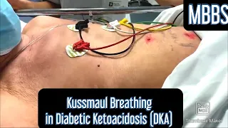 Kussmaul Breathing seen in Diabetic Ketoacidosis (DKA) #mbbs #medicine #neetpg #aiims #usmle