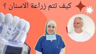 كيف تتم زراعة الاسنان ؟ زراعة الاسنان في  عمان  الدكتورة نائلة الدغمي ، افضل طبيب اسنان في عمان
