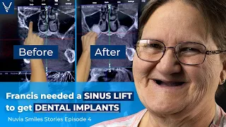 Francis gets a Sinus Lift before Dental Implants (Nuvia Smile Stories E4)